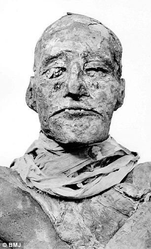 喉部伤口：法老拉美西斯三世的木乃伊上缠着亚麻裹尸布，这妨碍了研究人员发现他脖子上的伤口