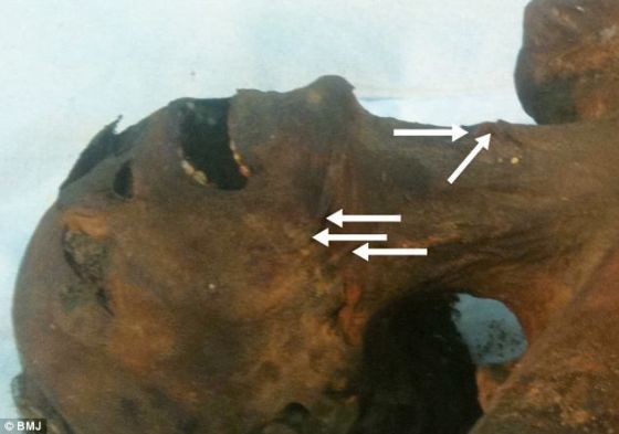 拉美西斯三世的颈部轴向CT剖面图：星迹指示的是他脖子上一道2.7英寸（6.86厘米）伤口的边缘处，箭头指向已经渗入伤口的防腐材料