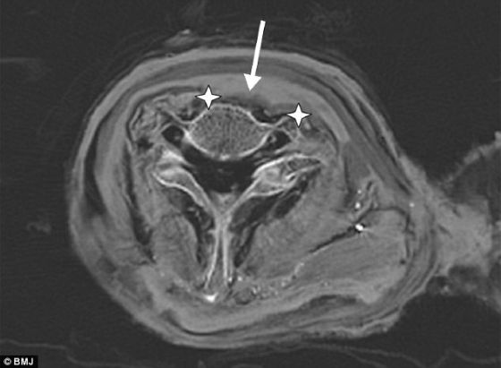 拉美西斯三世的颈部轴向CT剖面图：星迹指示的是他脖子上一道2.7英寸（6.86厘米）伤口的边缘处，箭头指向已经渗入伤口的防腐材料